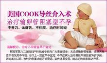 COOK導絲如何治療不孕癥